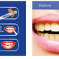 Teeth Whitening Pen